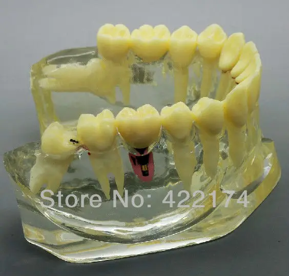 Бесплатная доставка протез для коррекции зубов модель исследования