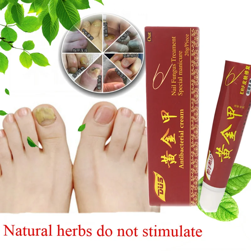 

Anti Fungal Nail Infection Nail Fungus Treatment Ointment Treatment Toe Nail Onychomycosis Paronychia Wholesale New 19 Medicine