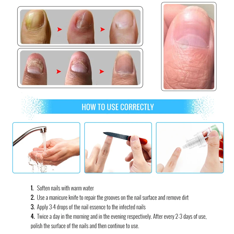 OMYLADY Лечение ногтей от грибка Essence Toe анти грибок для инфекции уход восстановление