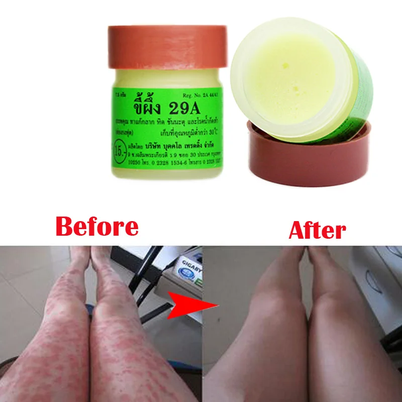 4 шт. профессиональная мазь для лечения псориаза оригинал из Вьетнама ингредиент