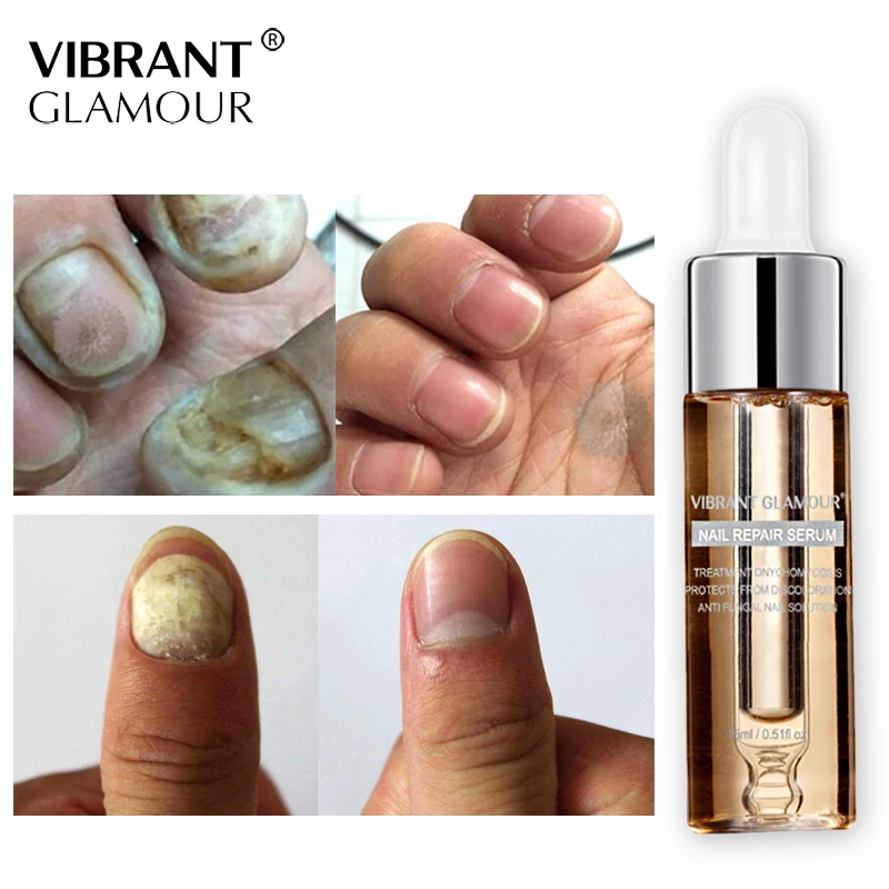 Vibrantglamur грибковый Уход за ногтями, сыворотка для ухода за ногами, гель для удаления грибка для ногтей, анти-инфекционный паронихический онихомикоз