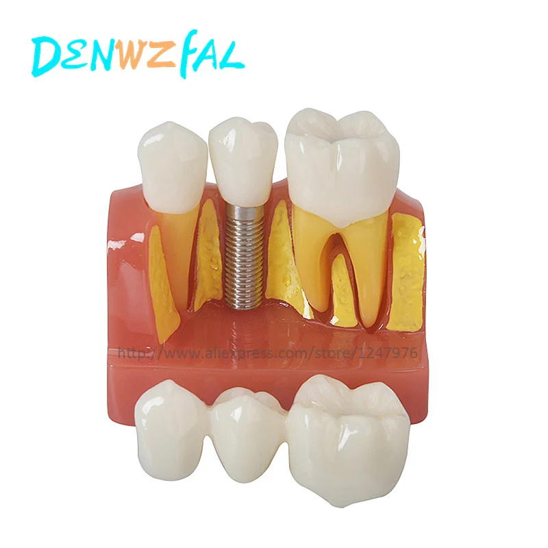 Four-fold implant interpretation model for dental teaching learning decomposition model