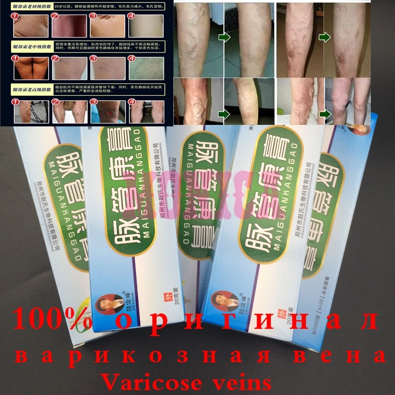 5 Пак варикозное расширение вен ноги кислота билгес зуд земляной червь комочки васкулит сосудистые воспаления массаж и релаксация