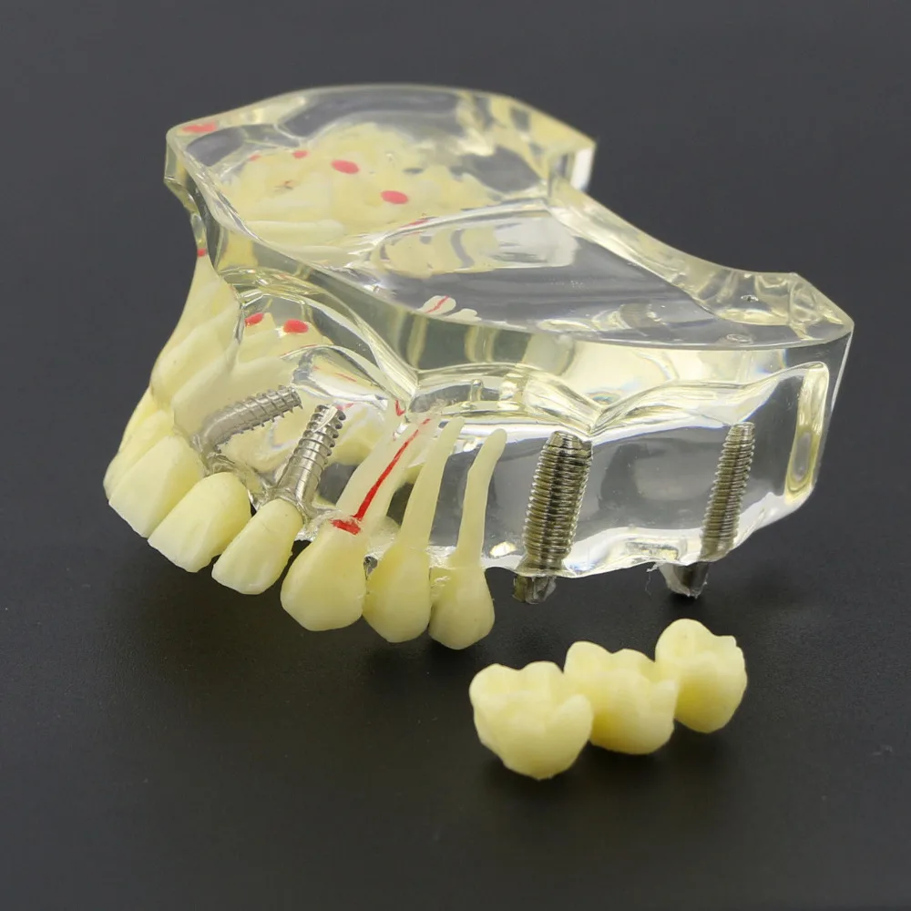 Зубные Исследование Научите Зубы Модель Dental Implant верхней челюсти модель с моста и кариеса