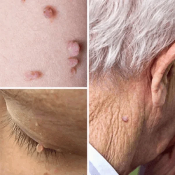 Скин для удаления этикеток медицинский Tu убить бирки кожи моль & женских половых