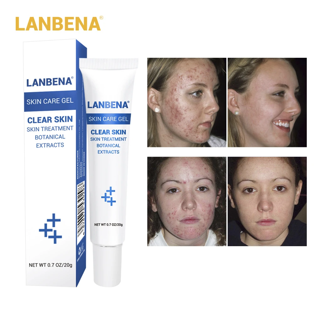 Крем Lanbena для лечения акне средство удаления угрей гель от очищение шрамы лица