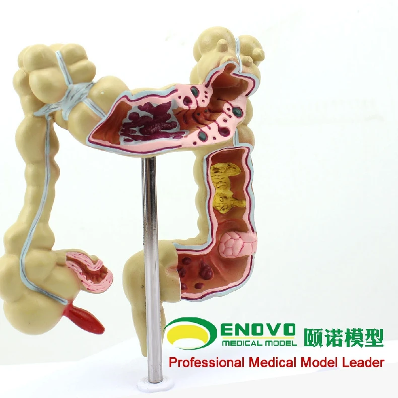 

Colorectal cancer colorectal cancer colorectal cancer gastrointestinal