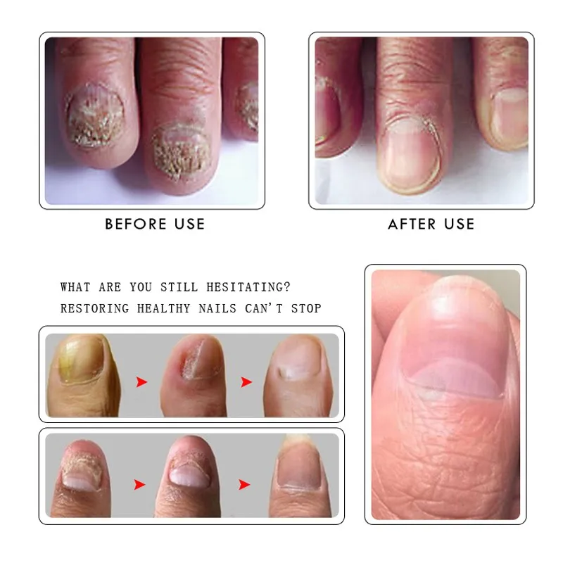 Новинка 2019 лечение грибковых ногтей отбеливание и ног имбирь антибактериальное