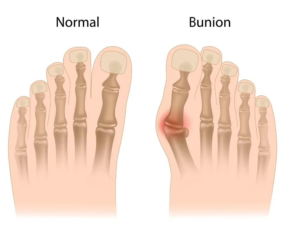 Ортопедический бандаж для большого пальца ноги черный бандажный ортопедический
