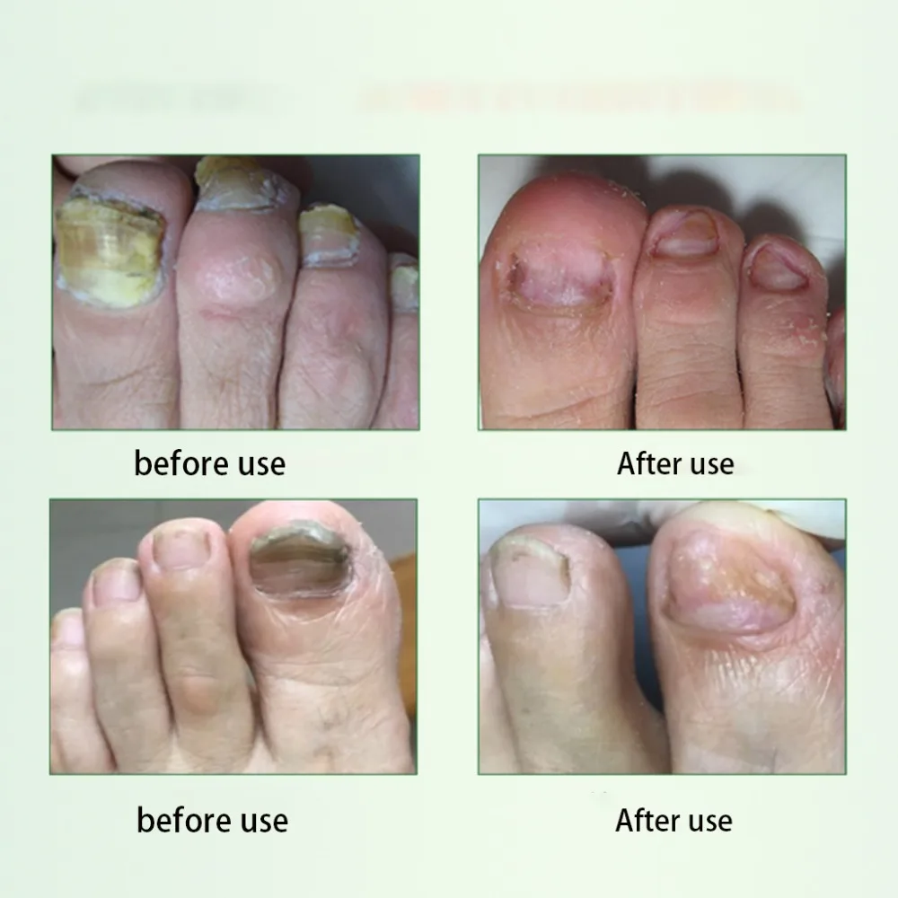 4 мл Профессиональный онихомикоз выделенный жидкий яркий натуральный