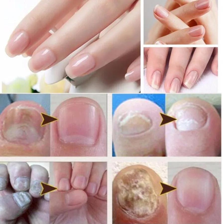 3 мл Китайская традиционная Onychomycosis dead Nail удалить Лечение Уход жидкая ручка смягчить Ноги Уход за ногами инструмент для лечения масляной ручки