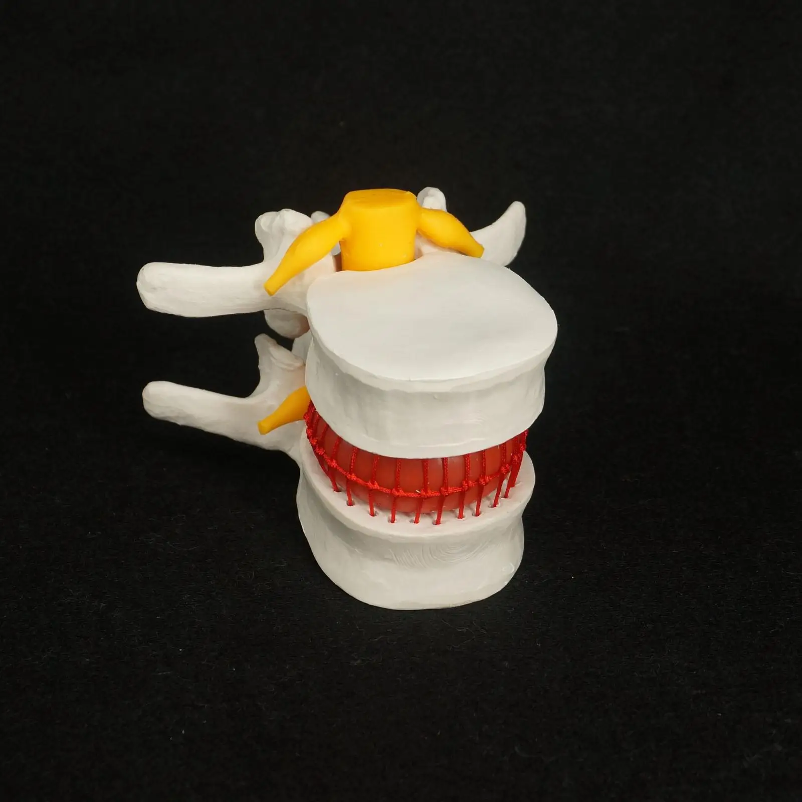 Анатомическая грыжа поясничных позвонков диск пролапс модель человека