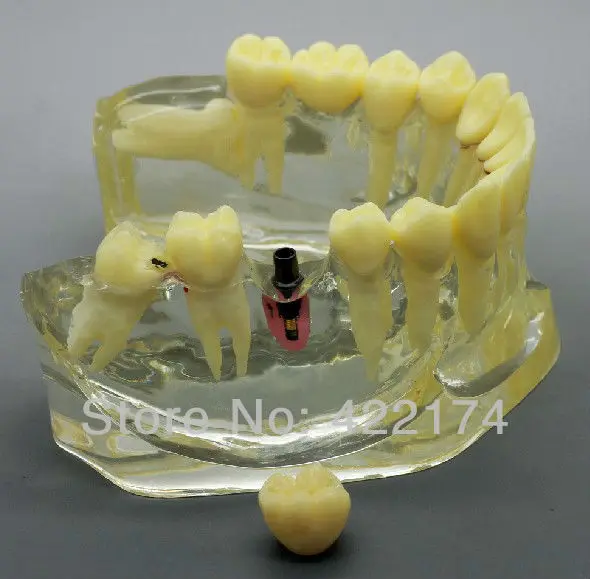 Бесплатная доставка протез для коррекции зубов модель исследования