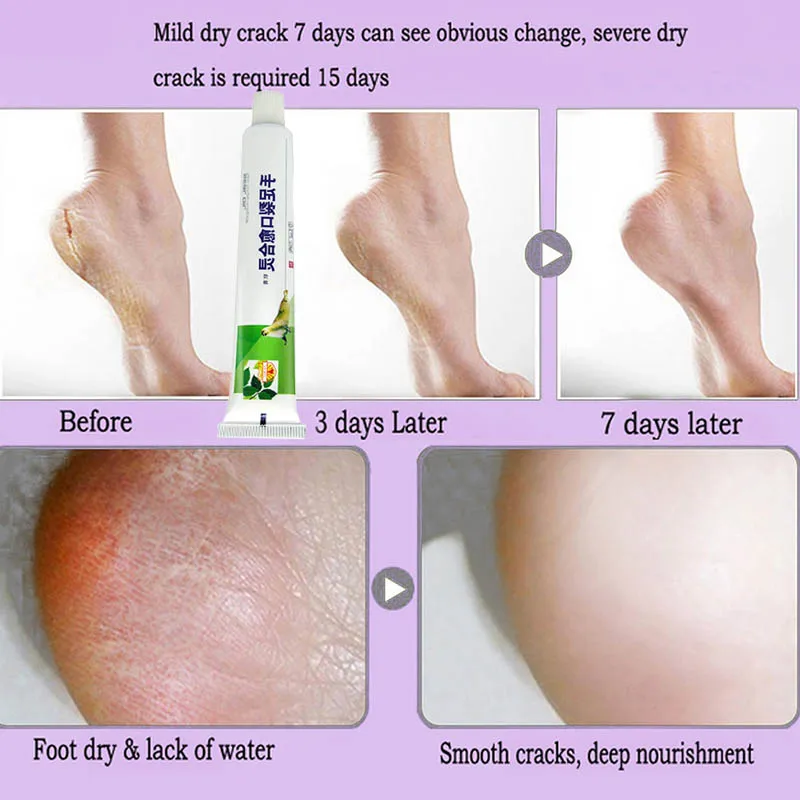 Мощный крем от трещин для ног рук пятка потрескающаяся пилинг и ремонт анти сухая