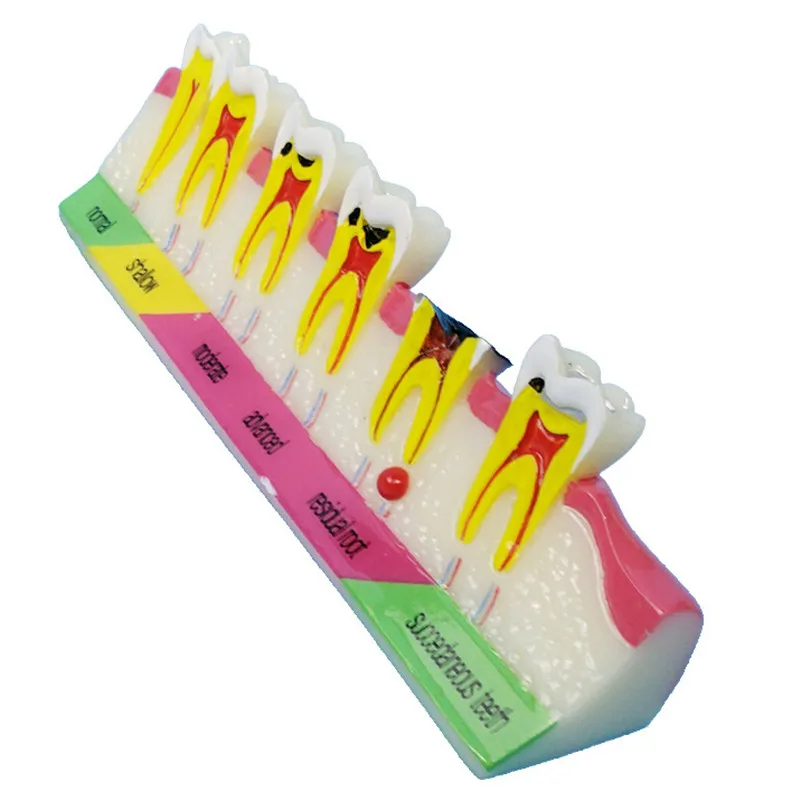 Зубные кариес модель обучение распад зубов Модель уход за зубами зубная для