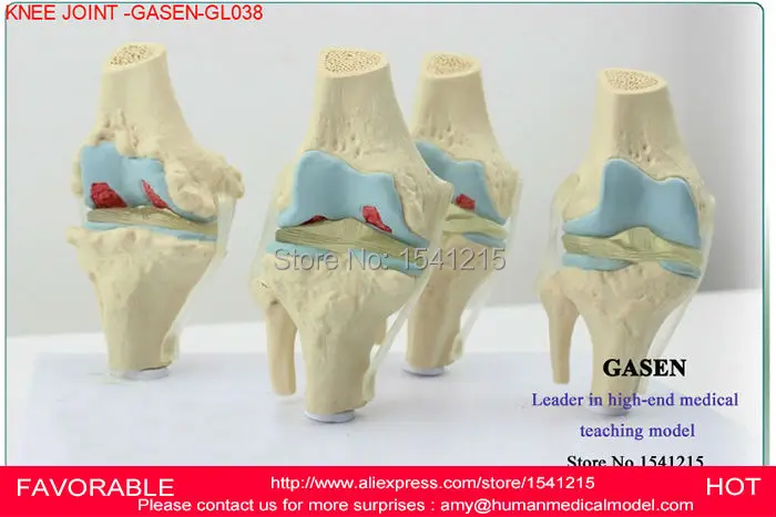 Модель коленного сустава модель человеческого скелета артропатия патология