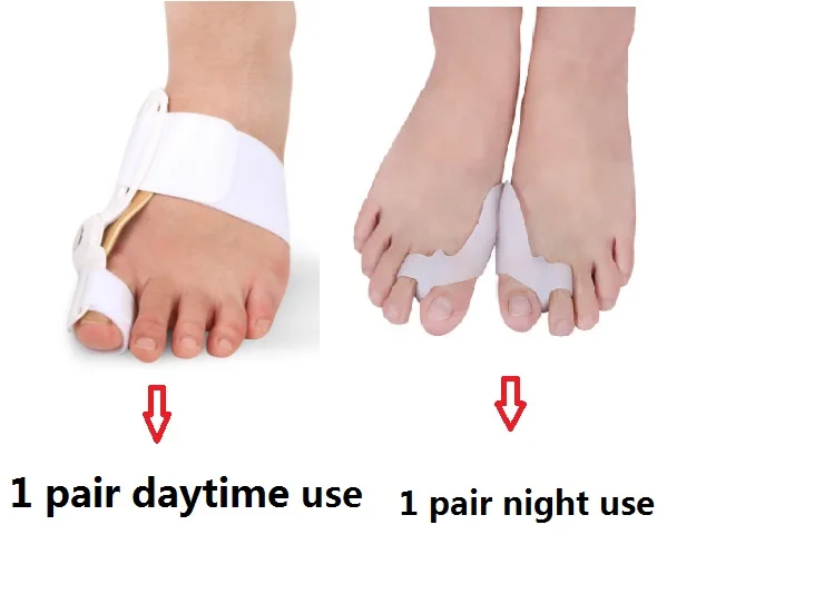 Вальгусное выравнивание при вальгусной деформации реабилитация большого пальца