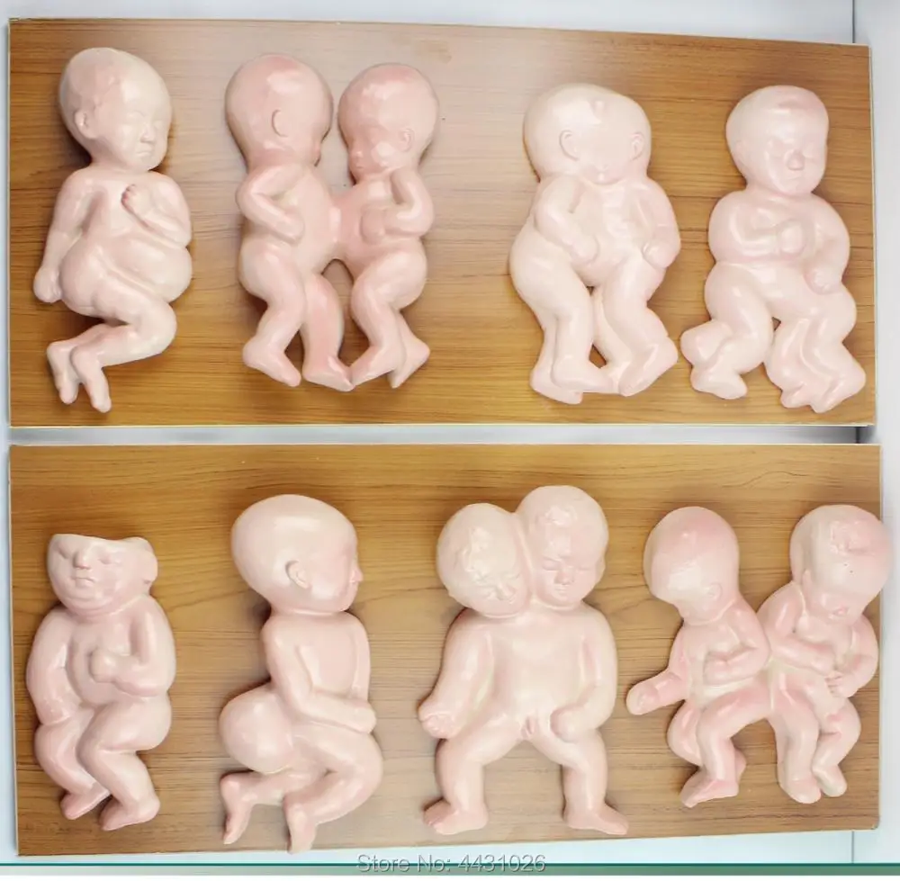 

ENOVO Family planning display deformed fetal model deformity infants and children demonstrate a gynaecological model