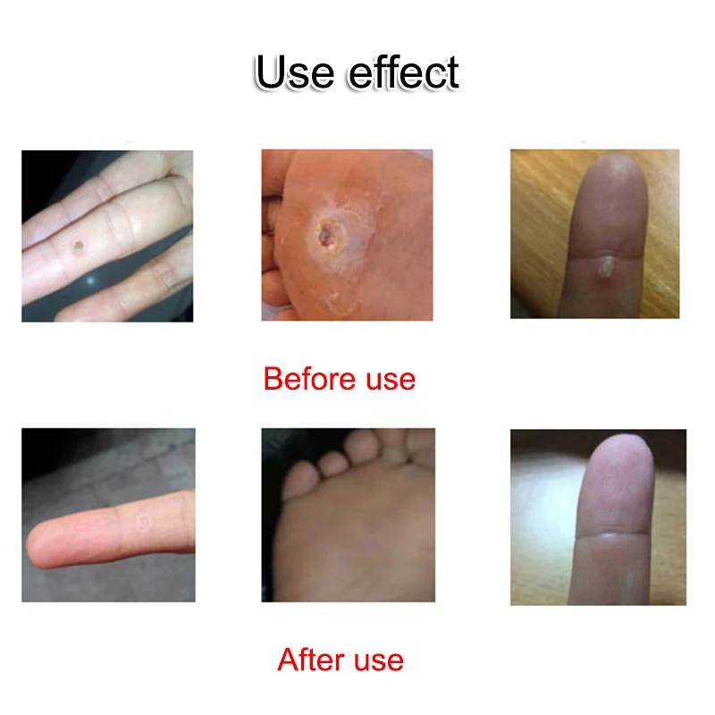 6 шт. отшелушивающая кукурузная пластырь для ног удаления омертвевшей кожи