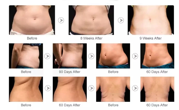 Radio Frequency RF Lipo Slim Liposuction Ultrasonic Body Cellulite Removal Weight Loss Slimming Vacuum 40k Cavitation Machine
