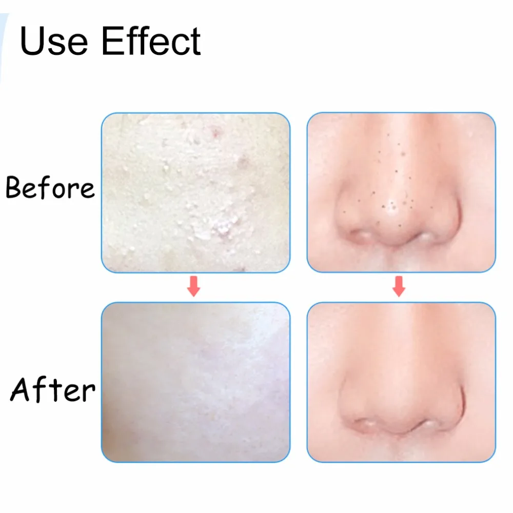 3 шт. практические игольчатый Пинцет для прыщей и черных точек с острым изгиб Клин