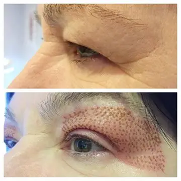 Высокая мощность Fibroblast плазменная ручка для крота темного пятна бородатые татуировки удаления морщин лица лифтинг век Plasmapen