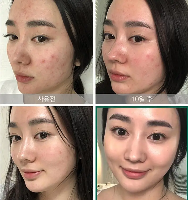 

SOME BY MI AHA BHA PHA 30 Days Miracle Cream Face Cream Blain Imprint Repair Cream Removal Acne Scar Treatment Facial Care
