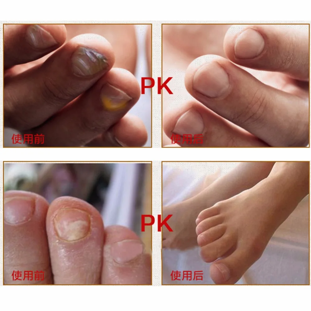 Оригинальный Лечение грибка на ногте экстракт отбеливание ногтей и ног с