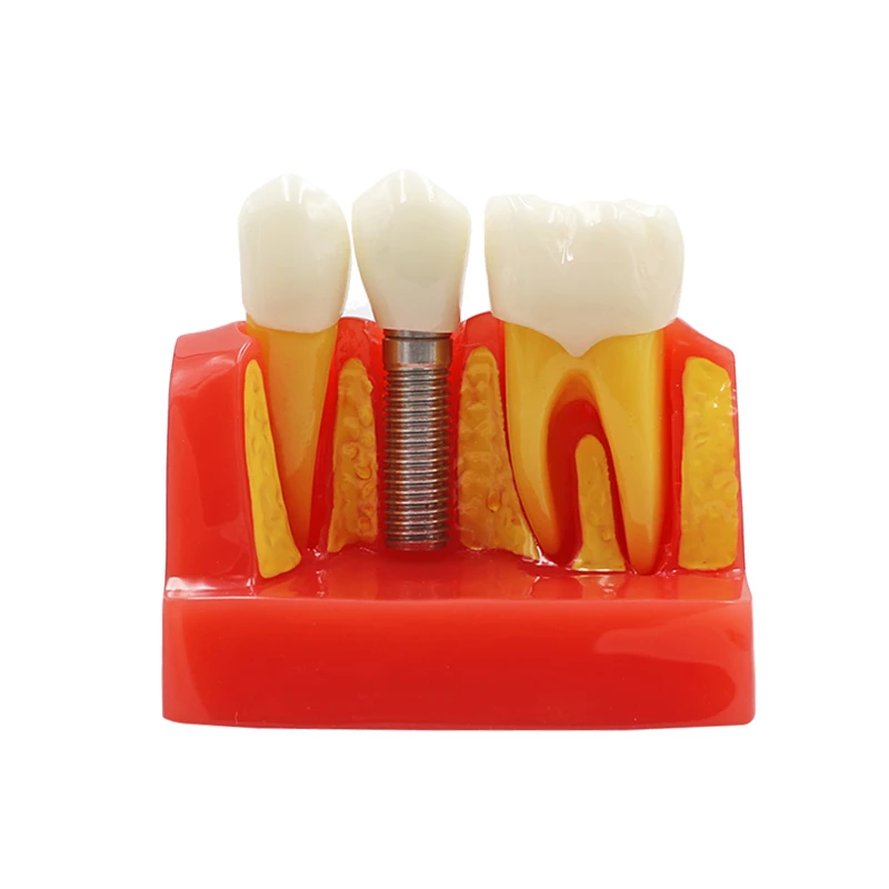 Четырехкратная модель зубного имплантата обучающая зубных имплантатов 4 модели