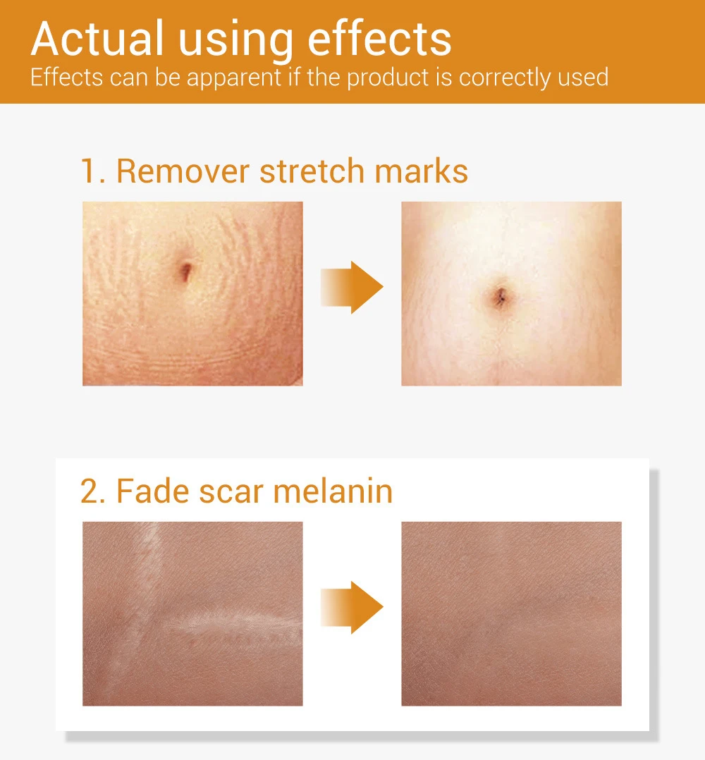 Новый Уход восстановление акне эссенция для удаления Растягивающихся