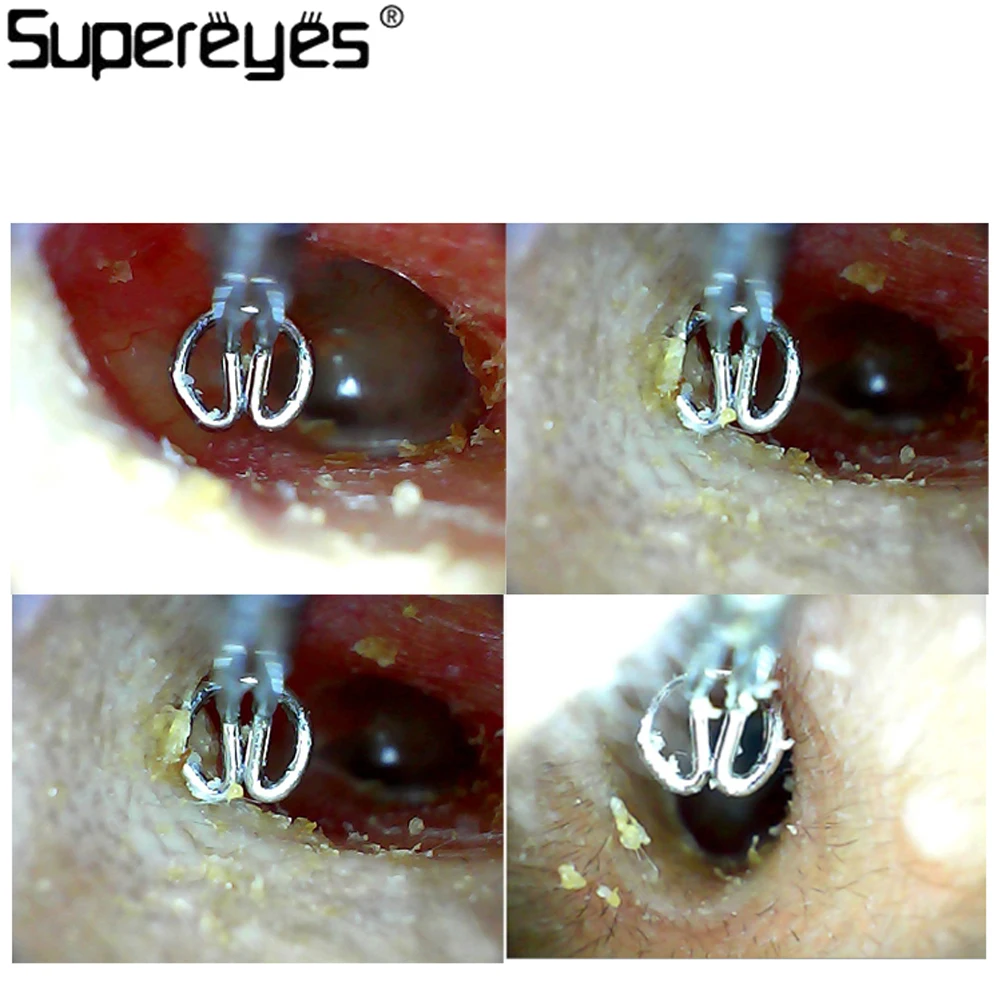 Supereyes Y004 цифровая видеосъемка для ушей с подсветкой Ушная кюрета удаление ушного