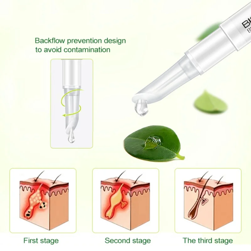 Натуральный дневной крем лечение акне гель масла Управление пятна уход за кожей