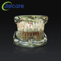 1 pc new dental study tooth transparent adult pathological and disease teaching teeth model removable dental lab equipment