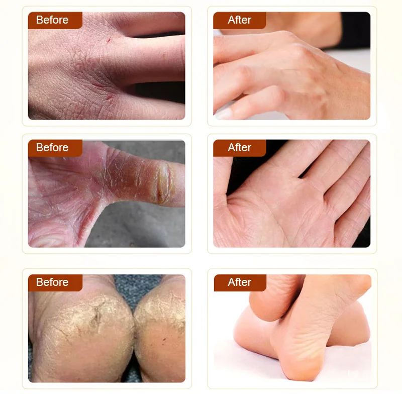 Крем для ног с конским маслом крем ухода за стопами мазь от зуда сжигания пилинга