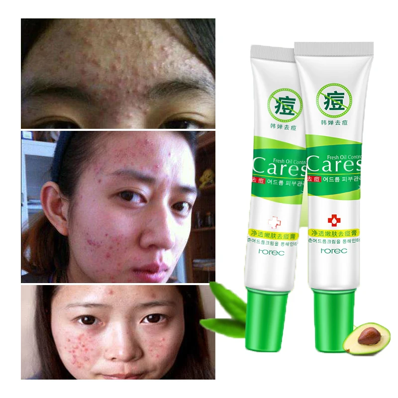 ROREC крем для акне уход за кожей удаление ремонт очищающий Comedone прыщи быстро лица