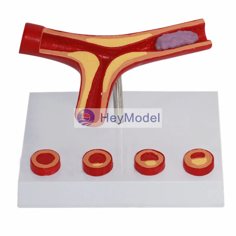 

HeyModel Human vascular atherosclerosis model
