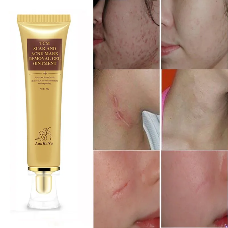 Крем для удаления шрамов и устранения черных точек 30 мл|removal cream|scar removal creamface cream |