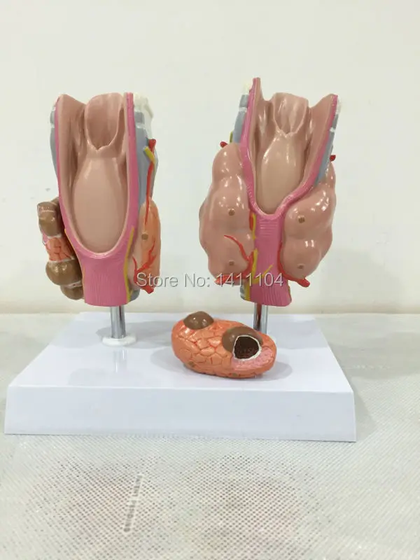 Бесплатная доставка гипертиреозь щитовидной железы гипотиреозь медицинская