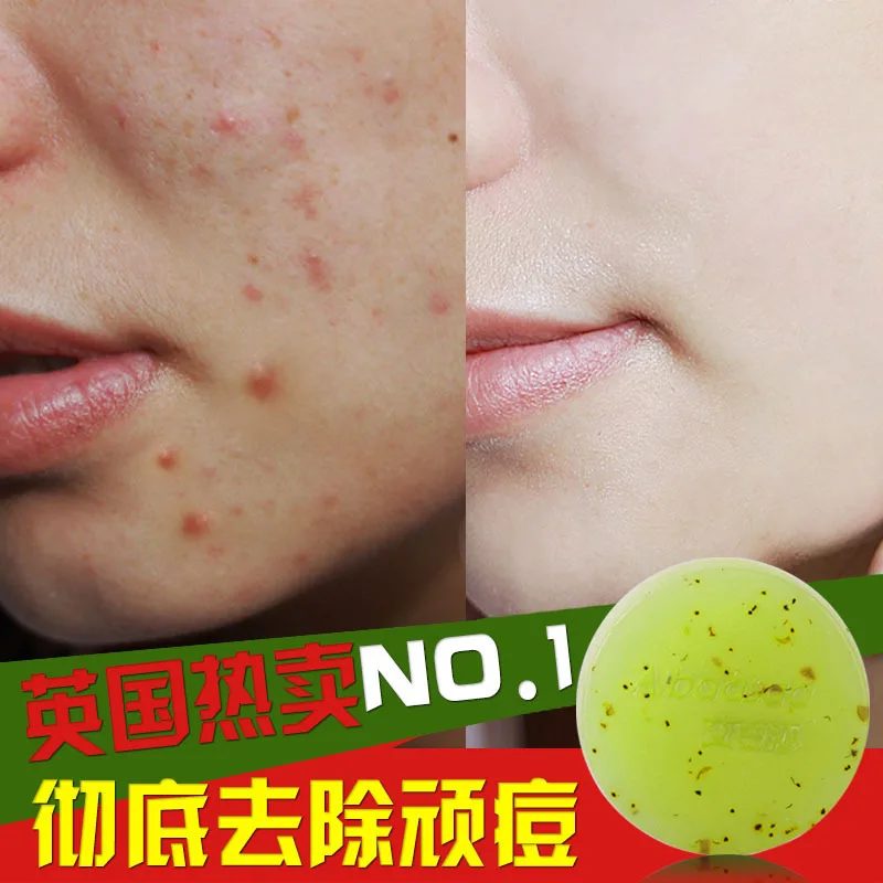 Face Care Saboneteira Tea Tree Remove Acne Soap Bubbles Whiten Oil Control Deep Clean Jabon Treatment soap Sabo ZYG579 | Красота и