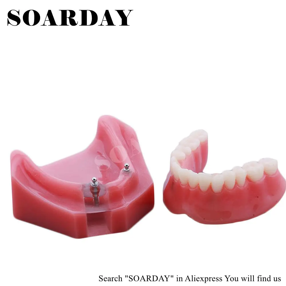 SOARDAY Overdenture нижняя с 2 имплантатами стоматологический зуб стоматолог