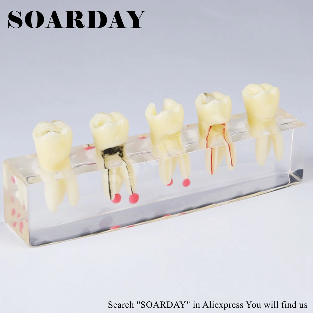 SOARDAY реставрация корневого канала зуба модель оральных стоматологических