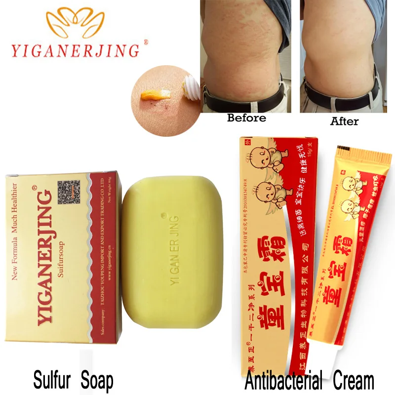 Серное мыло yiganerjing состояние кожи от акне псориаза крем Seborrhea Eczema Отбеливающее