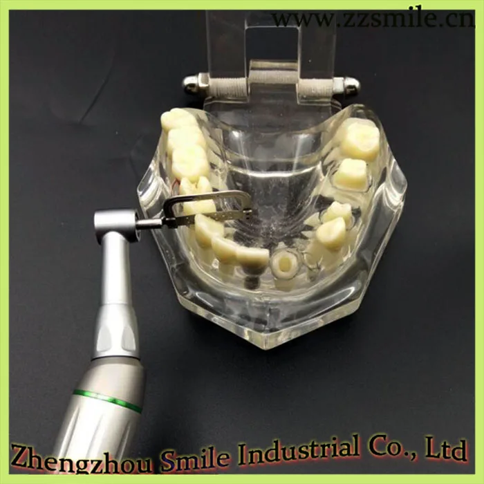 Стоматологическая Ортодонтическая поршневая интерпроксимальная Зачистка