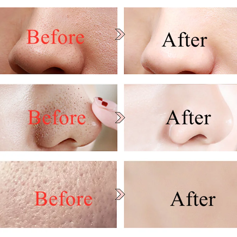 Средство для удаления угрей лица инструмент ухода за кожей Pore Cleaner электрический