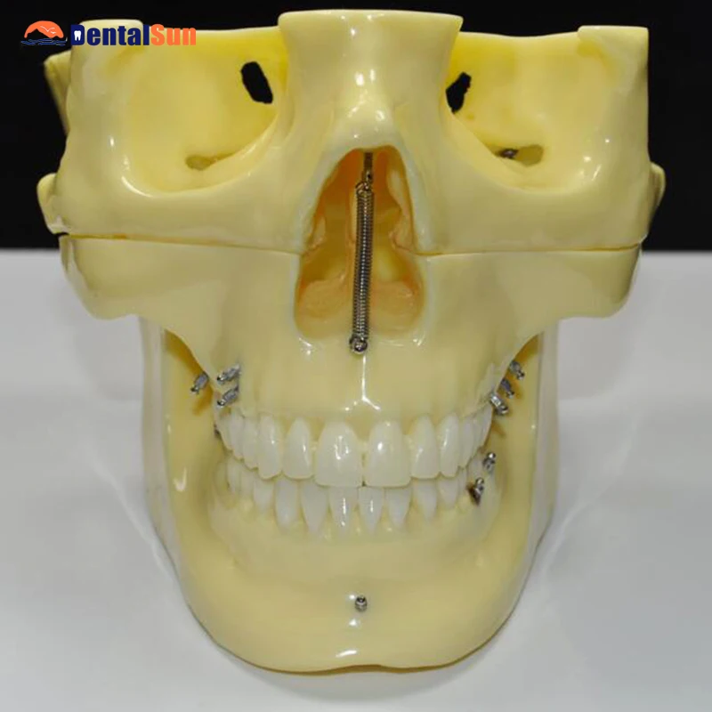 

Orthodontic Implant Teeth Model for Demonstration M2016