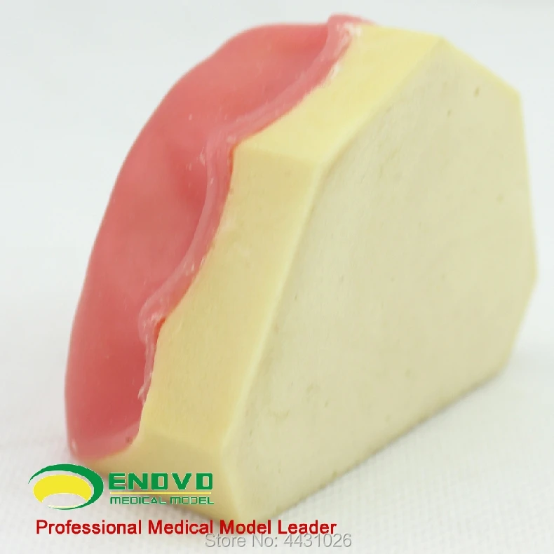 

ENOVO The training model of dental implant training was carried out in the oral cavity