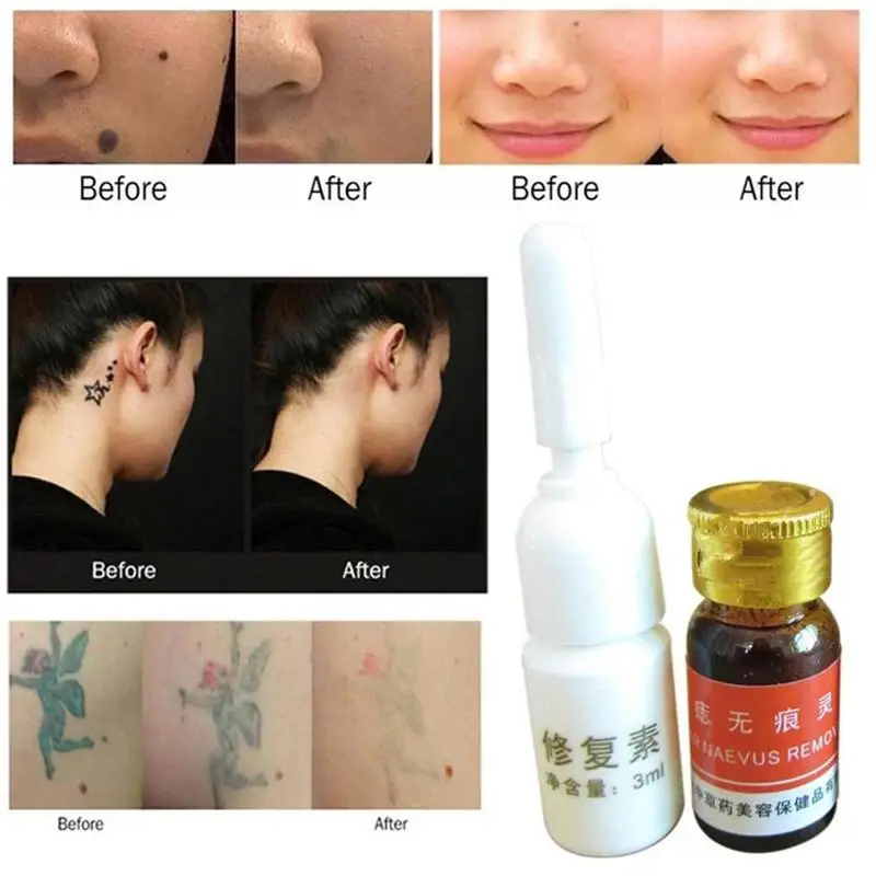 Раствор для удаления бородавок и пятен на коже безболезненный крем
