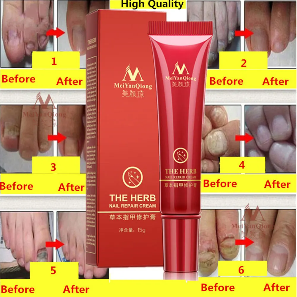 Nail Treatment Repair Cream Onychomycosis Paronychia Anti Fungal 100% Chinese Herbal Infection Toe | Красота и здоровье