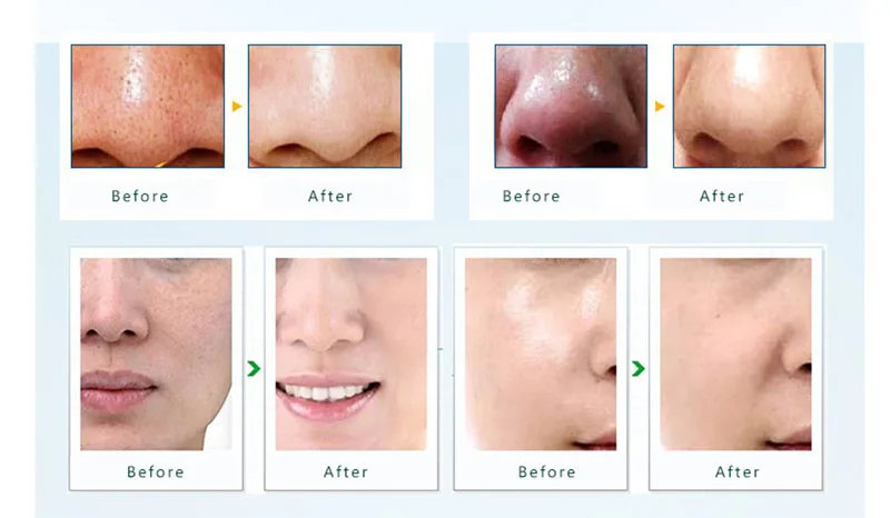 Лидер продаж! Средство для удаления черных точек акне прыщей вакуумное