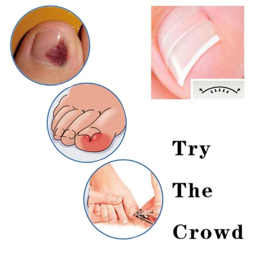 8 г Новый Paronychia клей для ногтей вросший Toenail корректирующий Педикюр Toe патч уход за